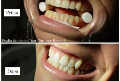 whitening